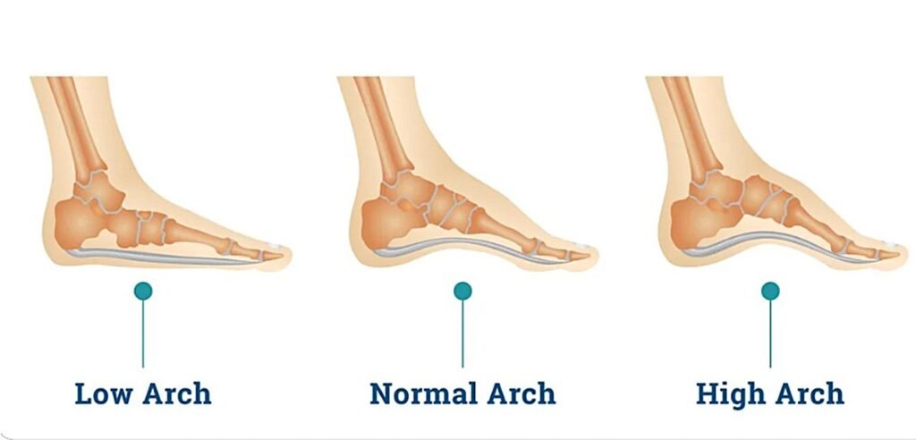 Arch type